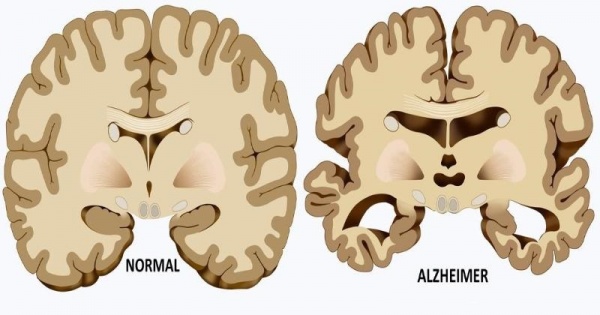 46 Million Americans May Have Pre Alzheimer Markers